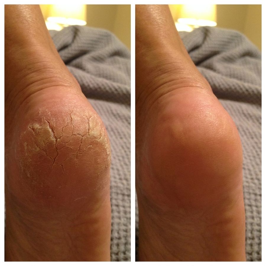 Side-by-side comparison: a deeply cracked heel on the left; a smooth, restored heel on the right after using Rive