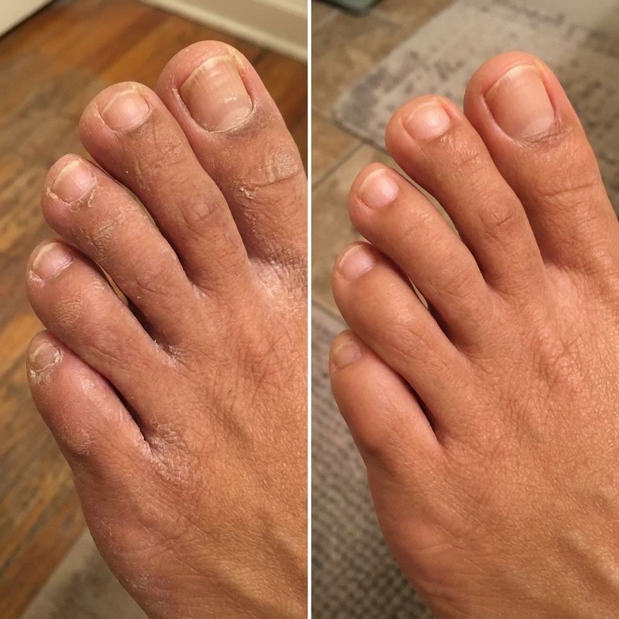 Side-by-side comparison: rough, cracked toe skin on the left; smooth, even toe skin on the right after using Rive