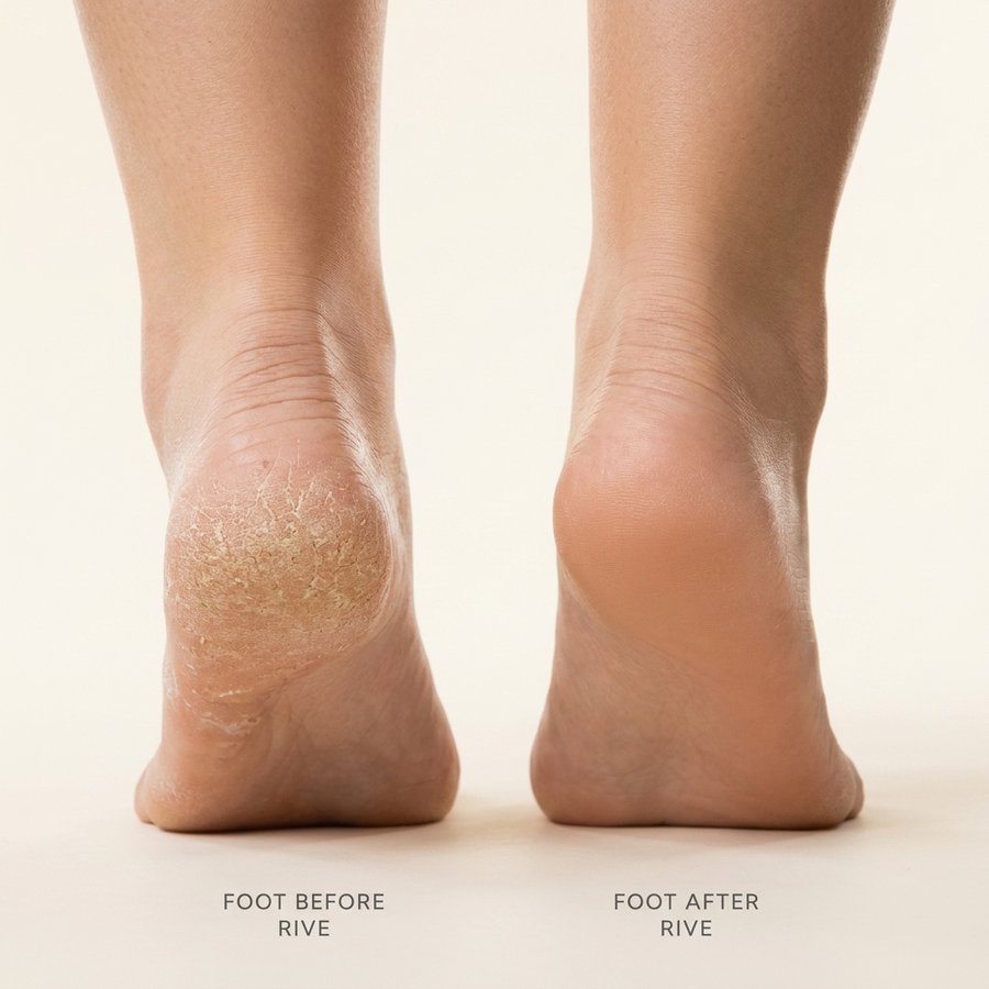 Side-by-side comparison: dry, cracked heel labeled FOOT BEFORE RIVE next to a smooth, restored heel labeled FOOT AFTER RIVE